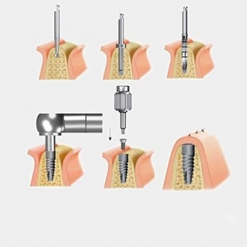 MÁNG HƯỚNG DẨN PHẨU THUẬT (CẮT NỨU)